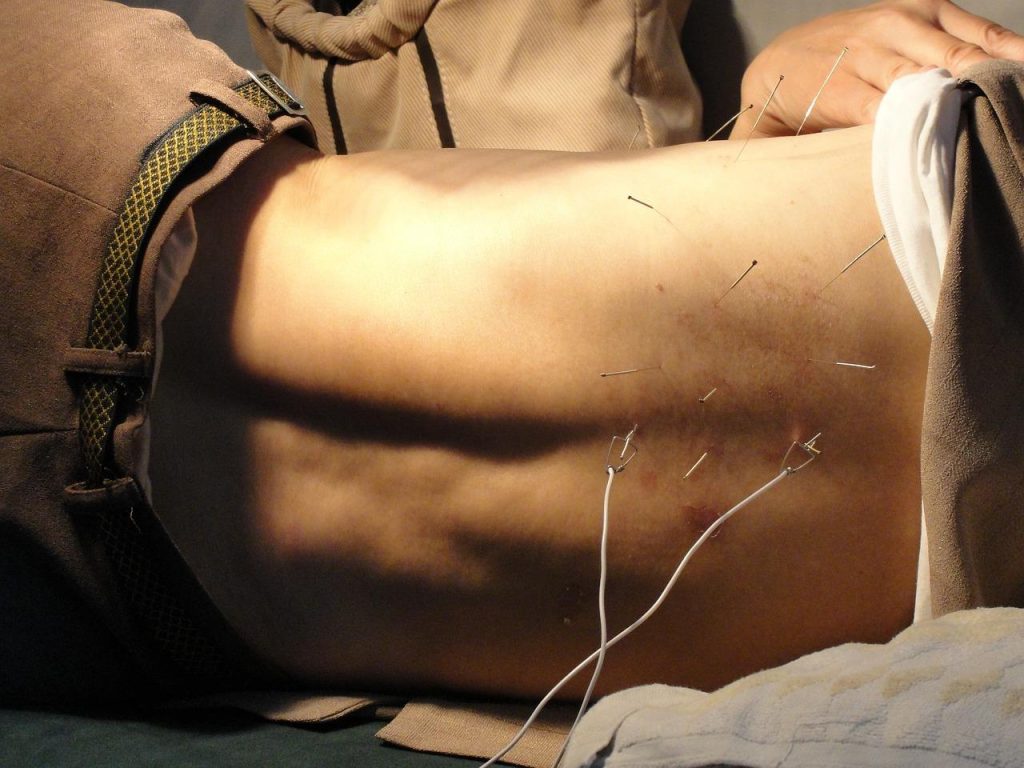 De patiënt ligt op zijn zij voor een acupunctuurbehandeling in Amersfoort