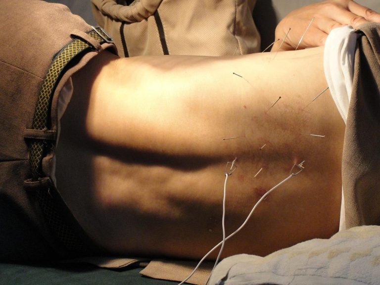 De patiënt ligt op zijn zij voor een acupunctuurbehandeling in Amersfoort